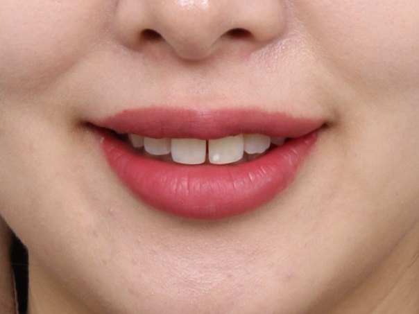치료 전 웃는 모습 · 가운데 앞니 사이가 벌어진 상태