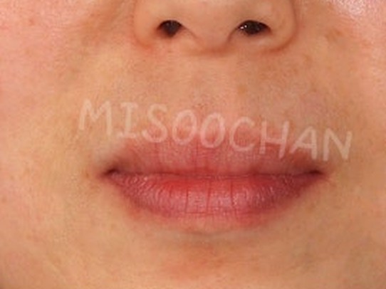 케이스 1 · 발치교정 후 팔자주름에 변화가 없는 정면 입 주변