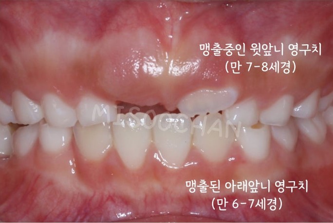 아래 영구 앞니는 이미 나왔고 위 영구 앞니가 나오고 있는 아이의 앞니