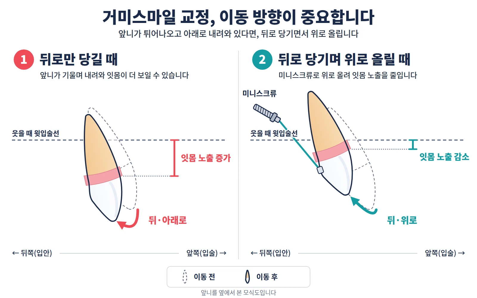 옆에서 본 위 앞니 모식도: 뒤로만 당기면 앞니가 기울며 내려와 잇몸 노출이 늘고, 미니스크류로 뒤로 당기며 위로 올리면 잇몸 노출이 줄어듭니다