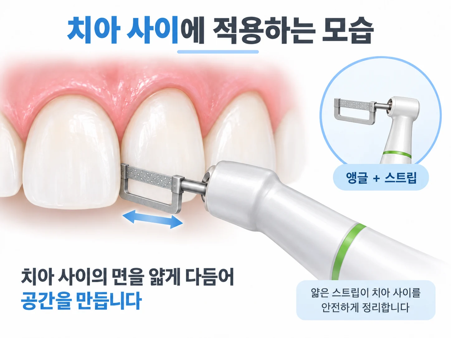 앵글에 끼운 스트립으로 앞니 사이의 면을 얇게 다듬는 모습