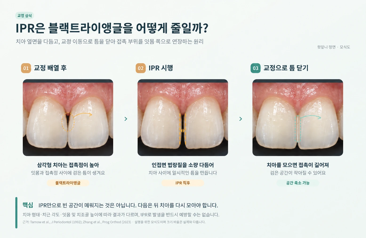 치간삭제로 블랙트라이앵글을 줄이는 원리: 삼각형 치아는 접촉점이 높아 검은 틈이 생기고, 인접면 법랑질을 소량 다듬은 뒤 교정으로 치아를 모으면 접촉이 잇몸 쪽으로 길어져 검은 공간이 작아질 수 있음