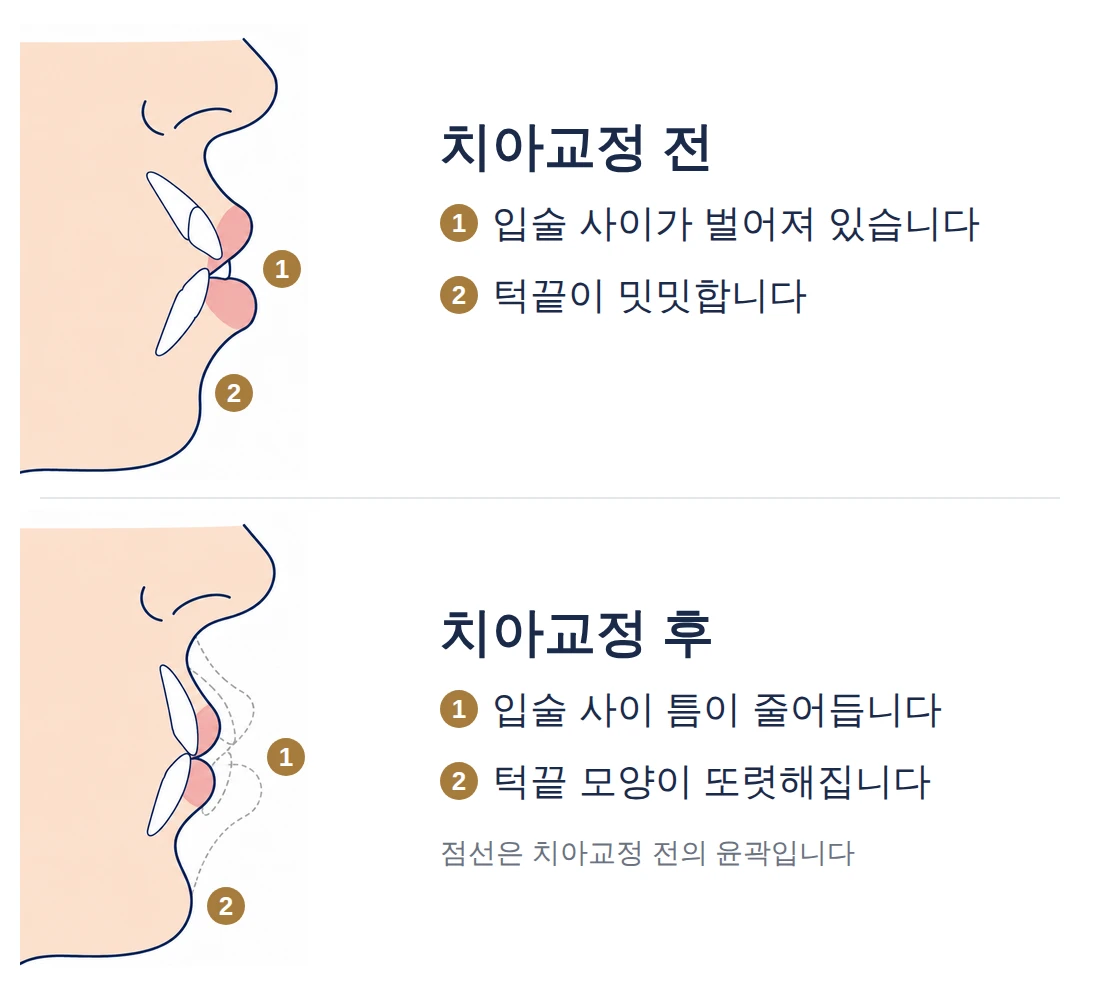 돌출입 교정 전후 옆모습 모식도: 치아교정 전에는 앞니가 앞으로 나와 입술 사이가 벌어지고 턱끝이 밋밋하지만, 치아교정 후에는 앞니와 입술이 뒤로 들어가 입술 사이 틈이 줄고 턱끝 모양이 또렷해집니다