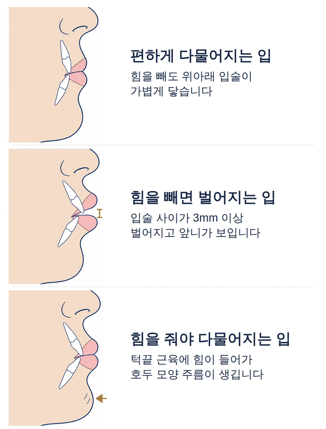 옆에서 본 입술 모식도: 힘을 빼도 입술이 가볍게 닿는 입, 힘을 빼면 입술 사이가 3mm 이상 벌어지는 입, 힘을 줘야 다물어지고 턱끝에 호두 모양 주름이 생기는 입