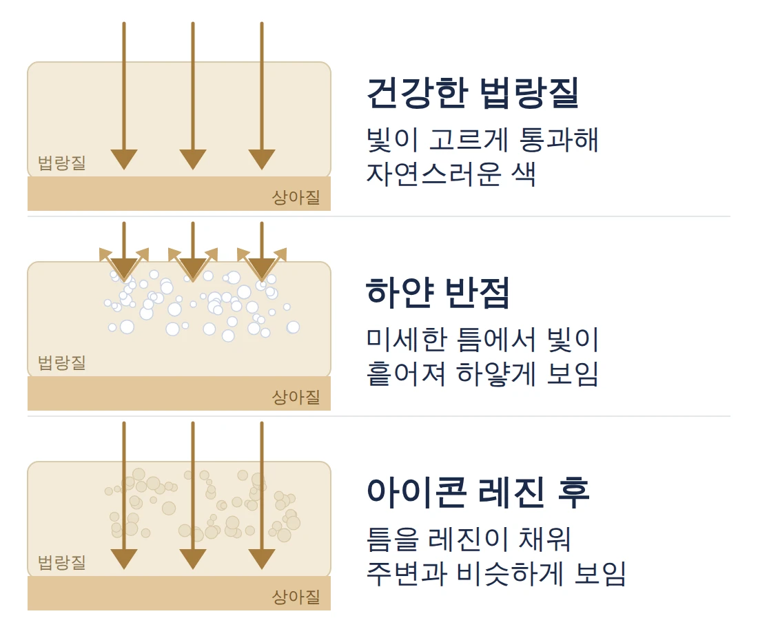 치아 단면 모식도: 건강한 법랑질은 빛이 고르게 통과하고, 하얀 반점은 법랑질 속 미세한 틈에서 빛이 흩어져 하얗게 보이며, 아이콘 레진으로 틈을 채우면 주변과 비슷하게 보입니다