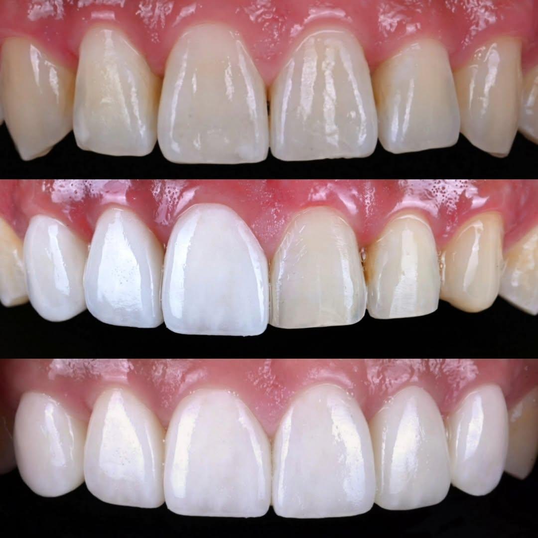Before, side-by-side comparison, and after — minimal-prep veneers