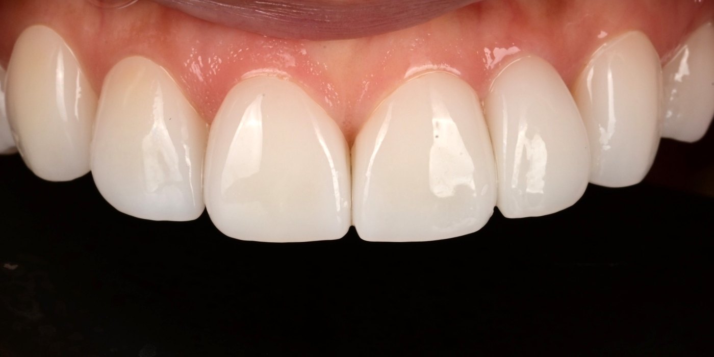 After milled lithium disilicate veneers