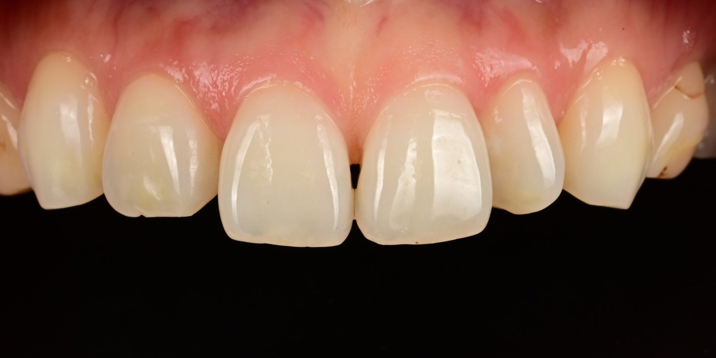 Before milled lithium disilicate veneers