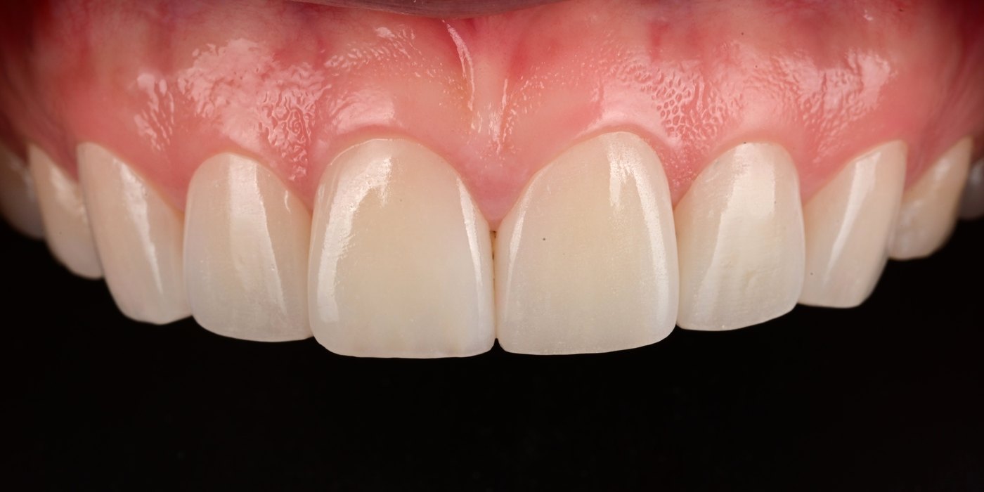 After hand-layered feldspathic veneers