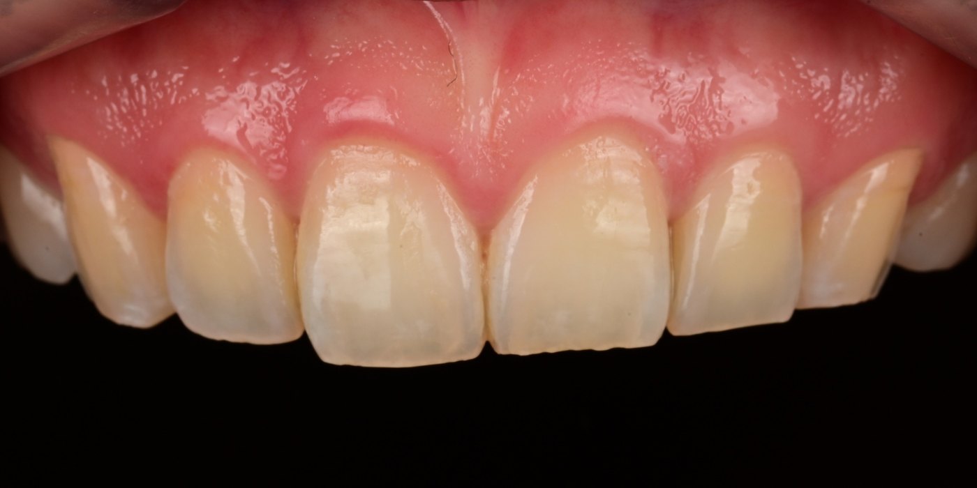 Before hand-layered feldspathic veneers