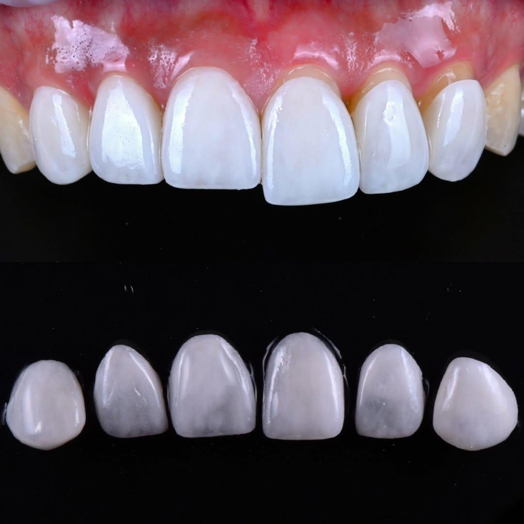 Completed veneers in the mouth, with the individual ceramic shells shown before bonding